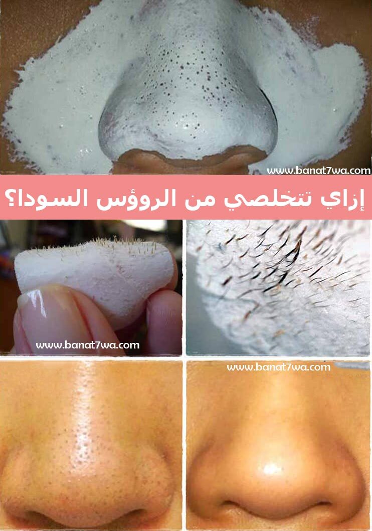 ماسك سحرى لعلاج الرؤوس السوداء
