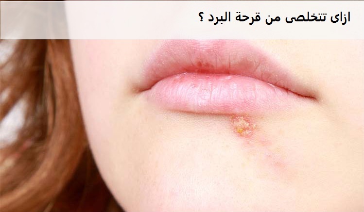 قرحة البرد 2