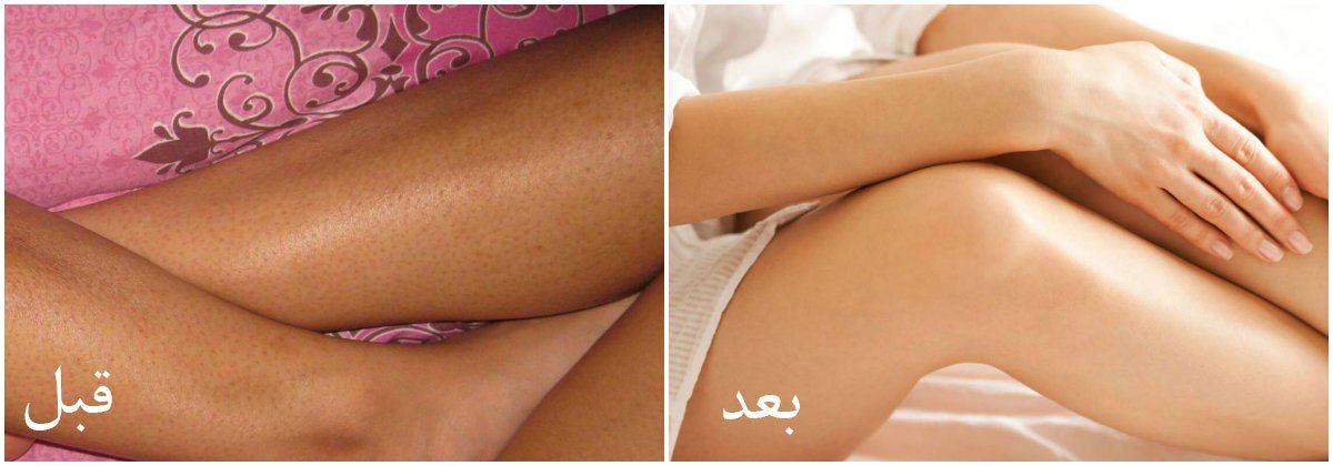 ازاي تتخلصي من المسام السودا في الرجل بطرق طبيعية ؟