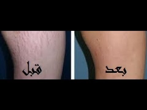علاج علامات تمدد الجلد