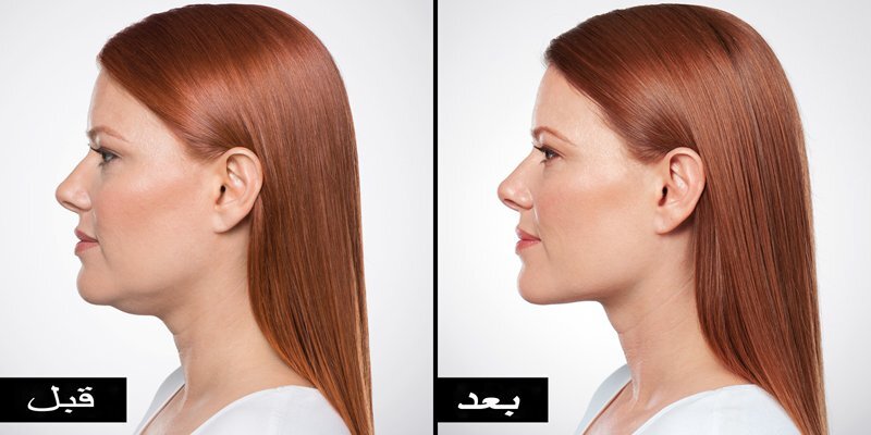 استخدام حمض Deoxycholic