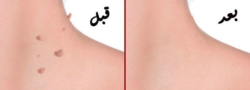 10 طرق طبيعية سهلة وفعالة لازالة الزوائد الجلدية