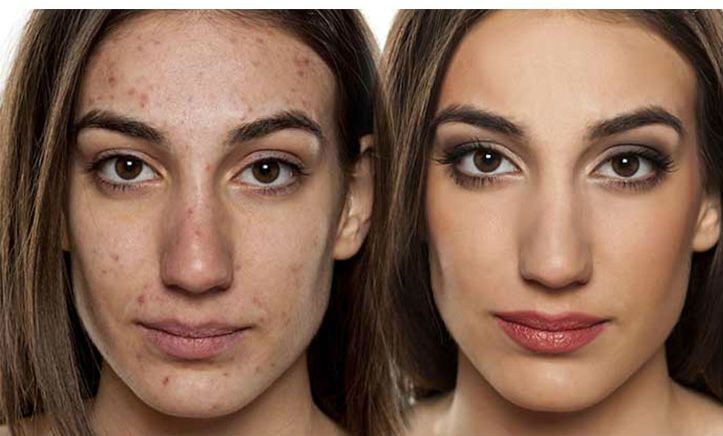 بالخطوات.. نصايح واسرار  ازاى تدارى حب الشباب بالـ makeup