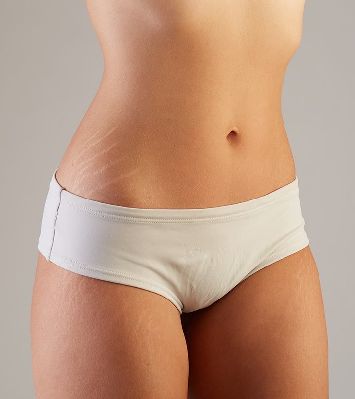 9 طرق بسيطة باستخدام زيت الخروع لعلاج ال Stretch Marks