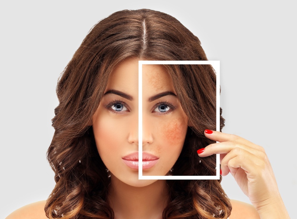 10 نصايح للتخلص من تصبغ البشرة بشكل طبيعي