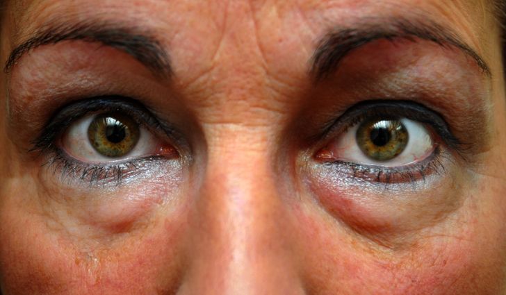 أسباب الهالات السوداء حول العين