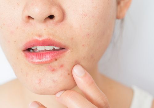 ايه هي المدة اللي بتحتاجها أدوية علاج حب الشباب عشان تعمل مفعول