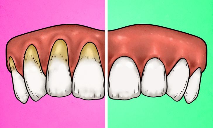 علامات الافراط في استخدام فرشة الاسنان 1