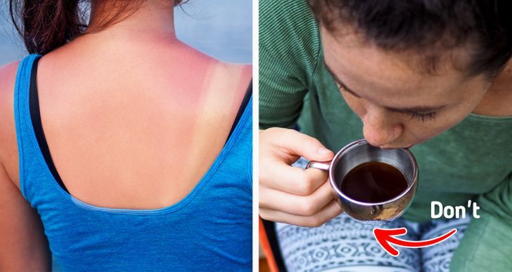 غلطات تجنبيها لو مصابة بحروق الشمس 3