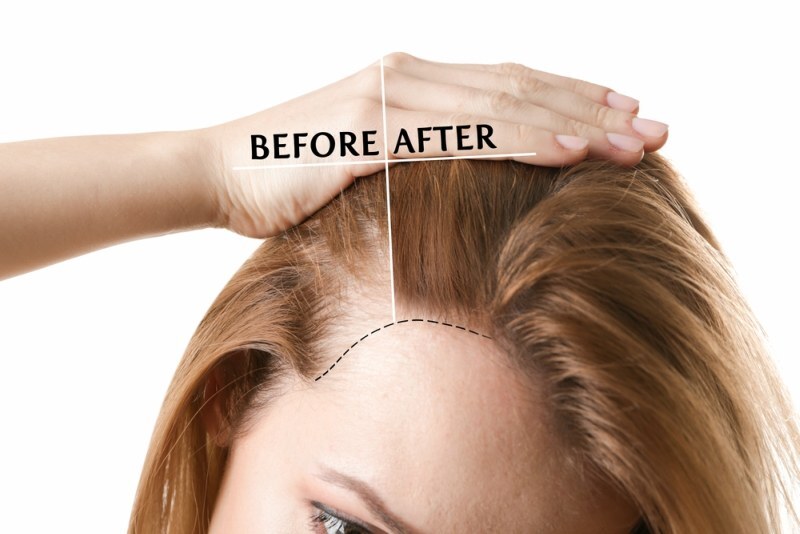 طرق وقف انحسار خط الشعر 4