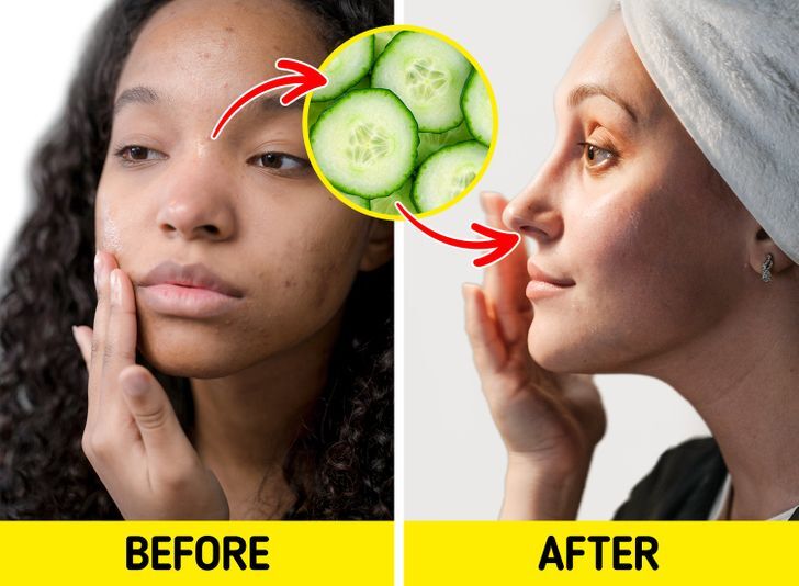 طرق طبيعية للتخلص من البثور 5