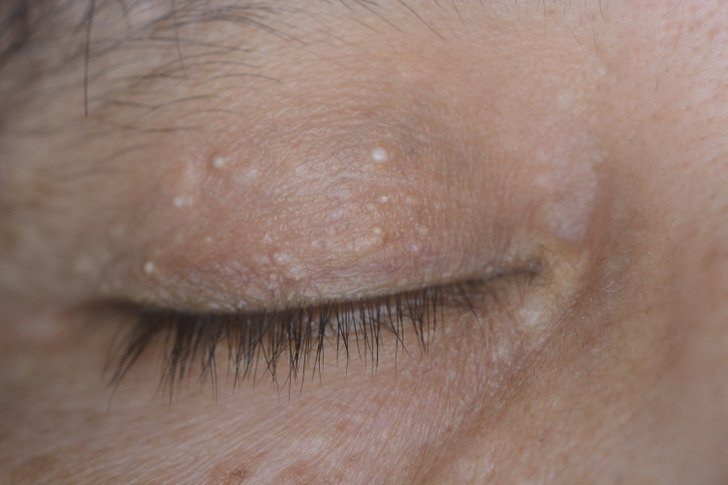 طرق علاج الحبوب البيضا 2