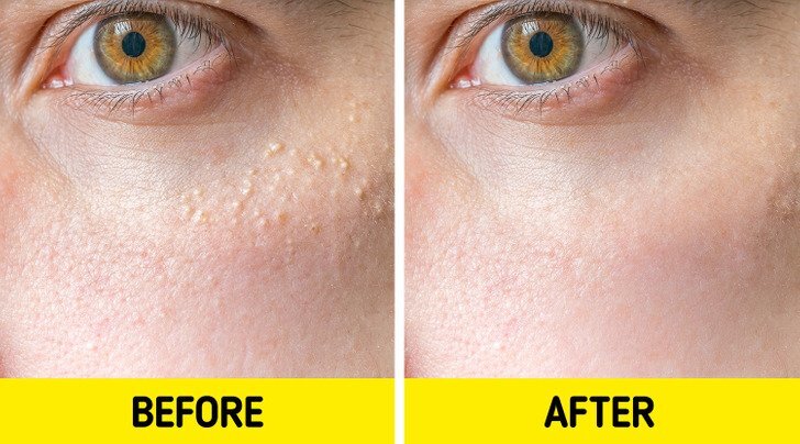 طرق علاج الحبوب البيضا 3