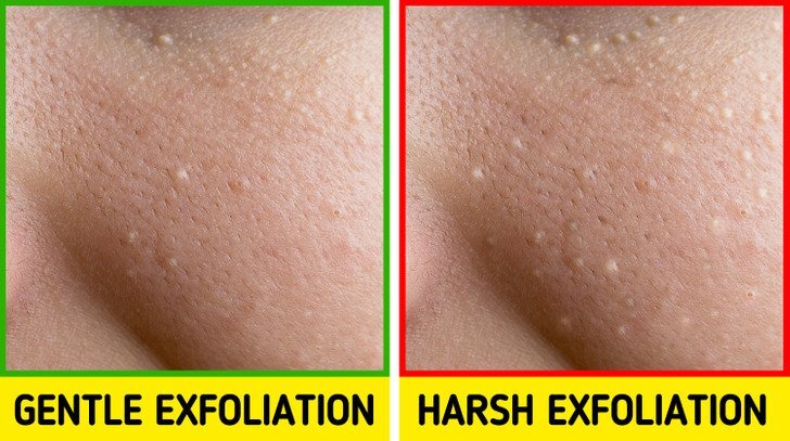 طرق علاج الحبوب البيضا 5
