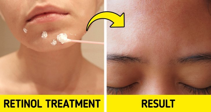 طرق علاج الحبوب البيضا 6