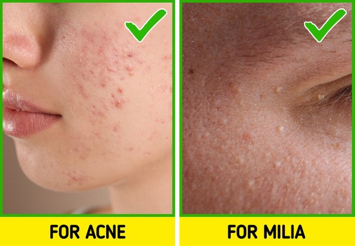 طرق علاج الحبوب البيضا 7