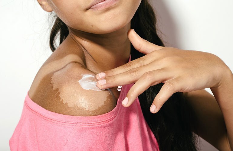 طرق التخلص من تقشير حروق الشمس 9