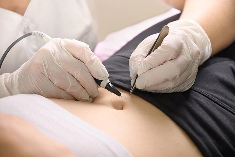التحليل الكهربائي لازالة الشعر 3