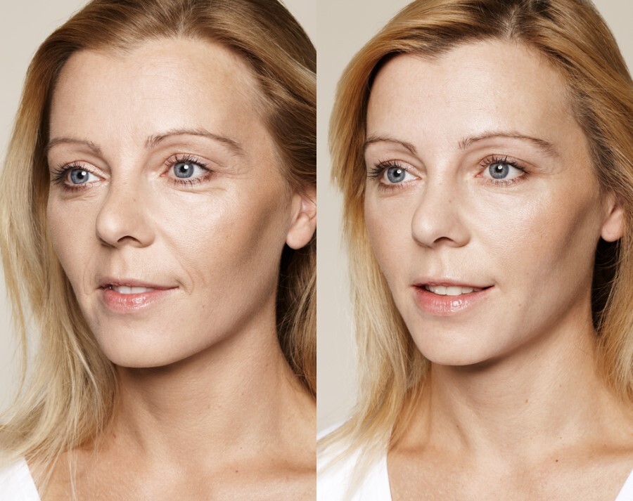 skin boosters 10