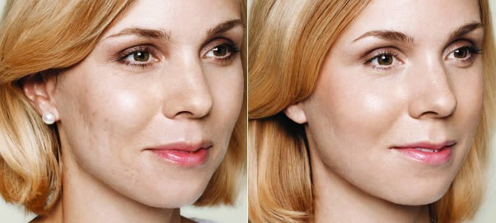 skin boosters 11
