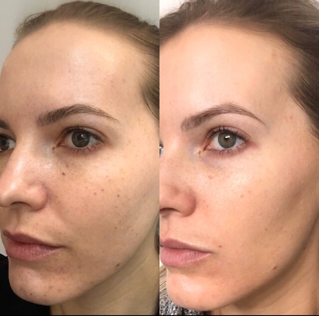 skin boosters 12