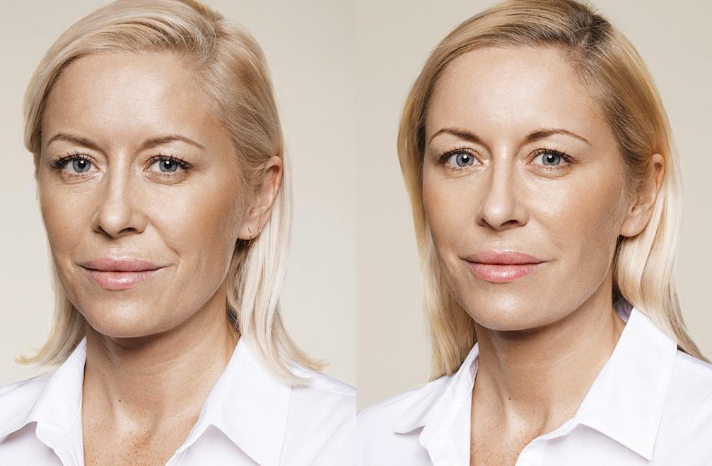 skin boosters 3