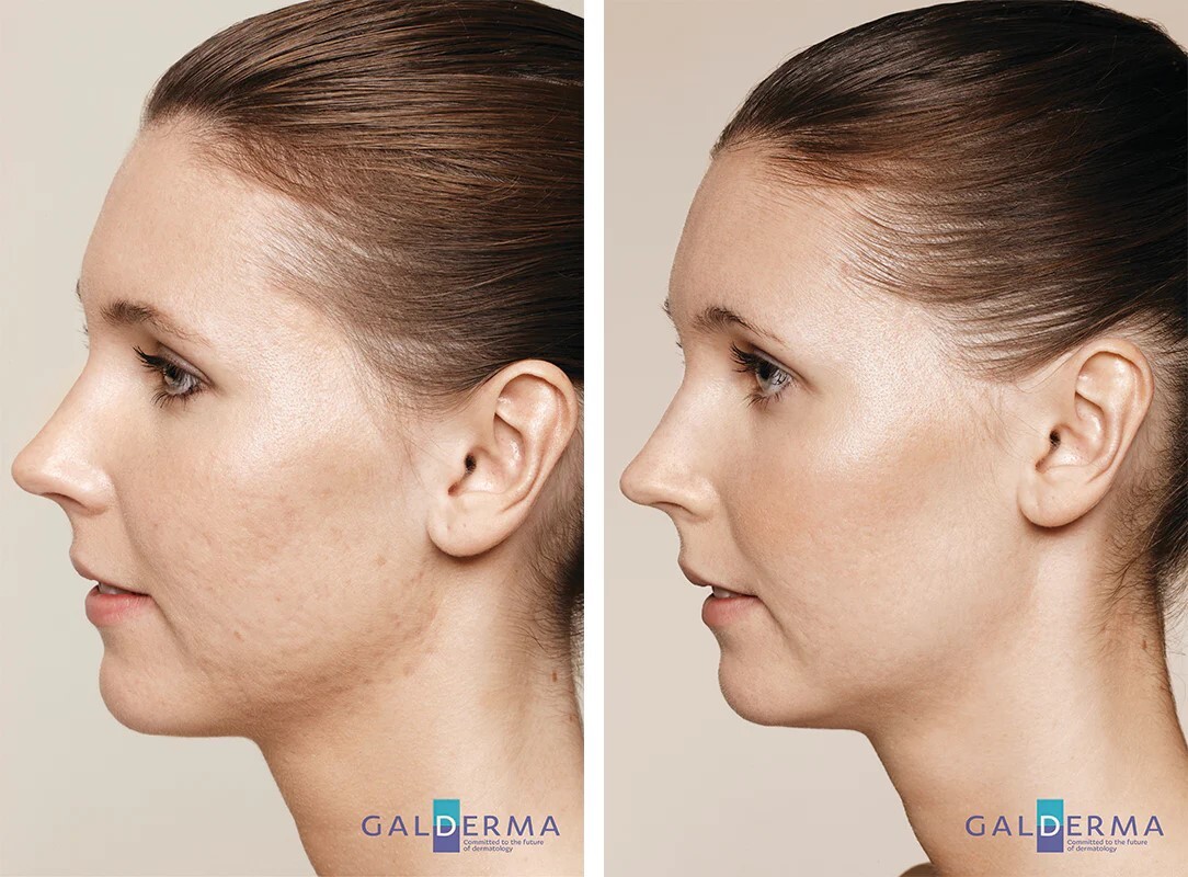 skin boosters 6