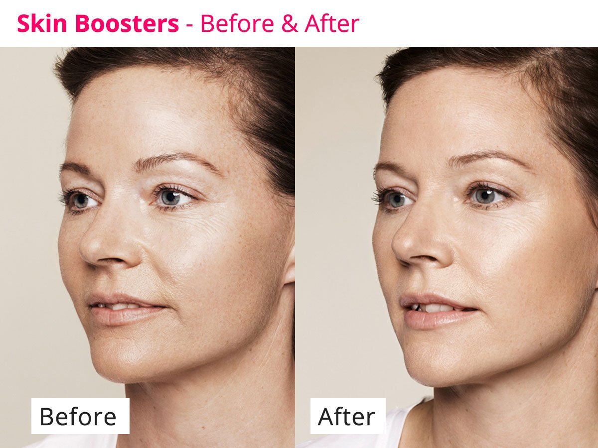 skin boosters 7