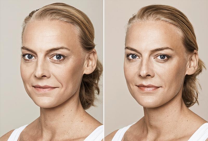 skin boosters 9