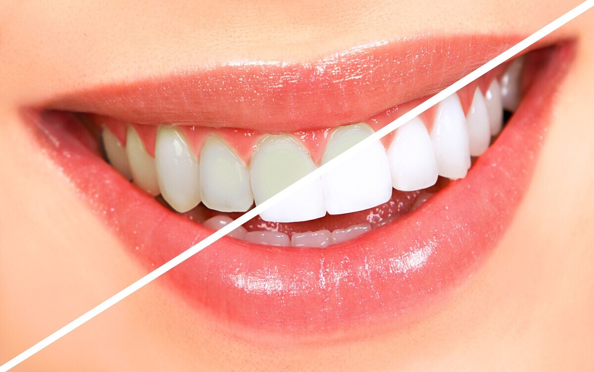 وصفات طبيعية لتبييض الاسنان 1