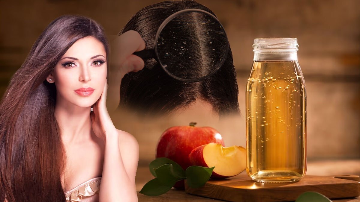 6 طرق تستخدمي بيهم خل التفاح لعلاج القشرة