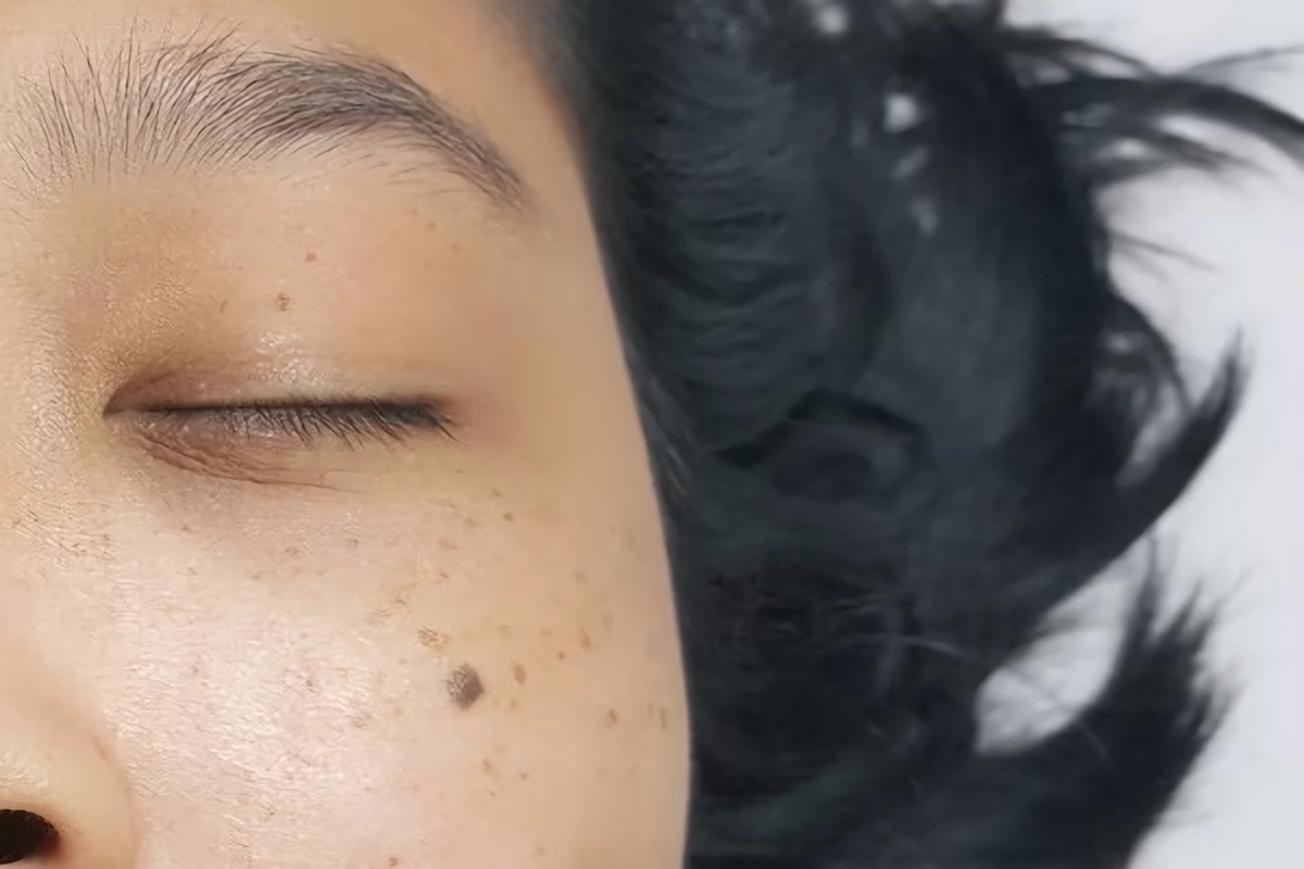 طرق علاج الثآليل 3