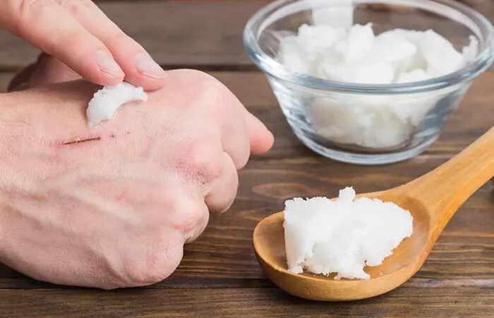 طريقة علاج الندبات بزيت جوز الهند 3