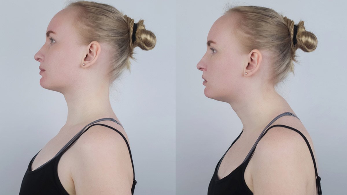 تمارين لعلاج حدبة الرقبة Neck hump.1 تمارين لعلاج حدبة الرقبة Neck hump.1